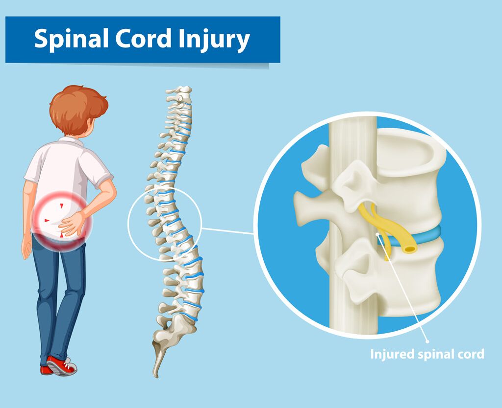 Back and spinal injury claims